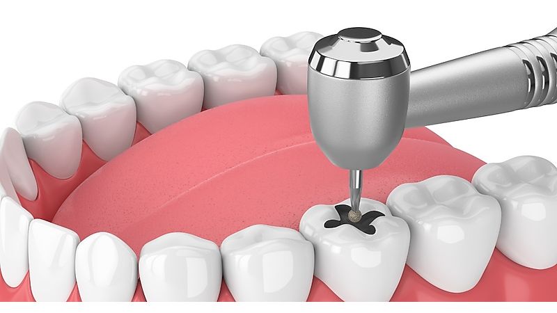 hàn răng 49k Yenle Dental